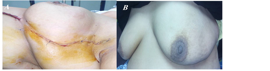 Breast Reconstruction - Dr Kollias