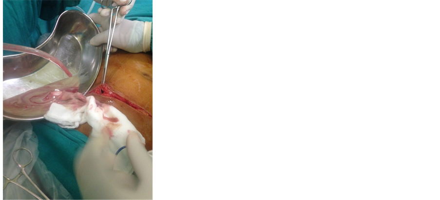 Laparoscopic inguinal hernia repair (TEP)