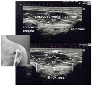 coracoacromial ligament tear