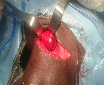 Laparoscopic Resection of an Epidermal Inclusion Cyst at the