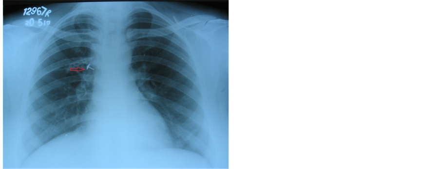 Late Presentation of Bronchial Foreign Body in Young Adult: A Case Report