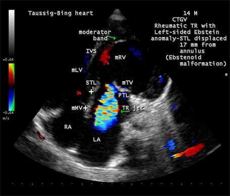 Rheumatic “Taussig-Bing Heart”: A Case Report
