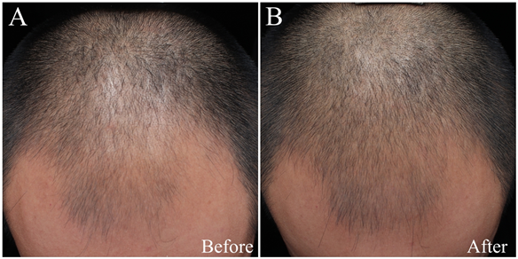 Concentrated Growth Factor from Autologous Platelet Promotes Hair Growth in  Androgenetic Alopecia