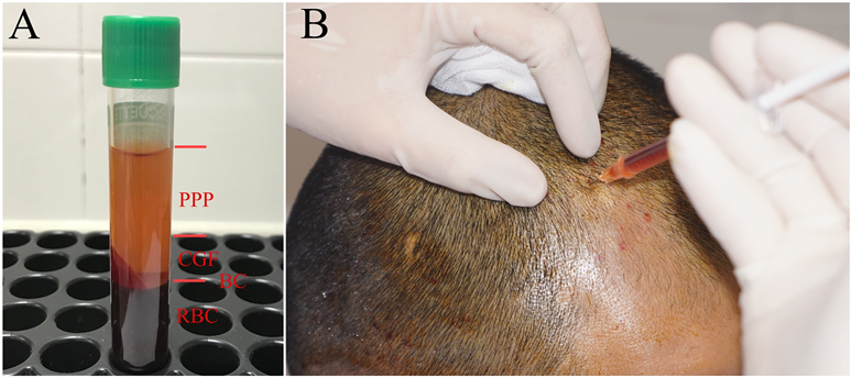 Concentrated Growth Factor from Autologous Platelet Promotes Hair Growth in  Androgenetic Alopecia
