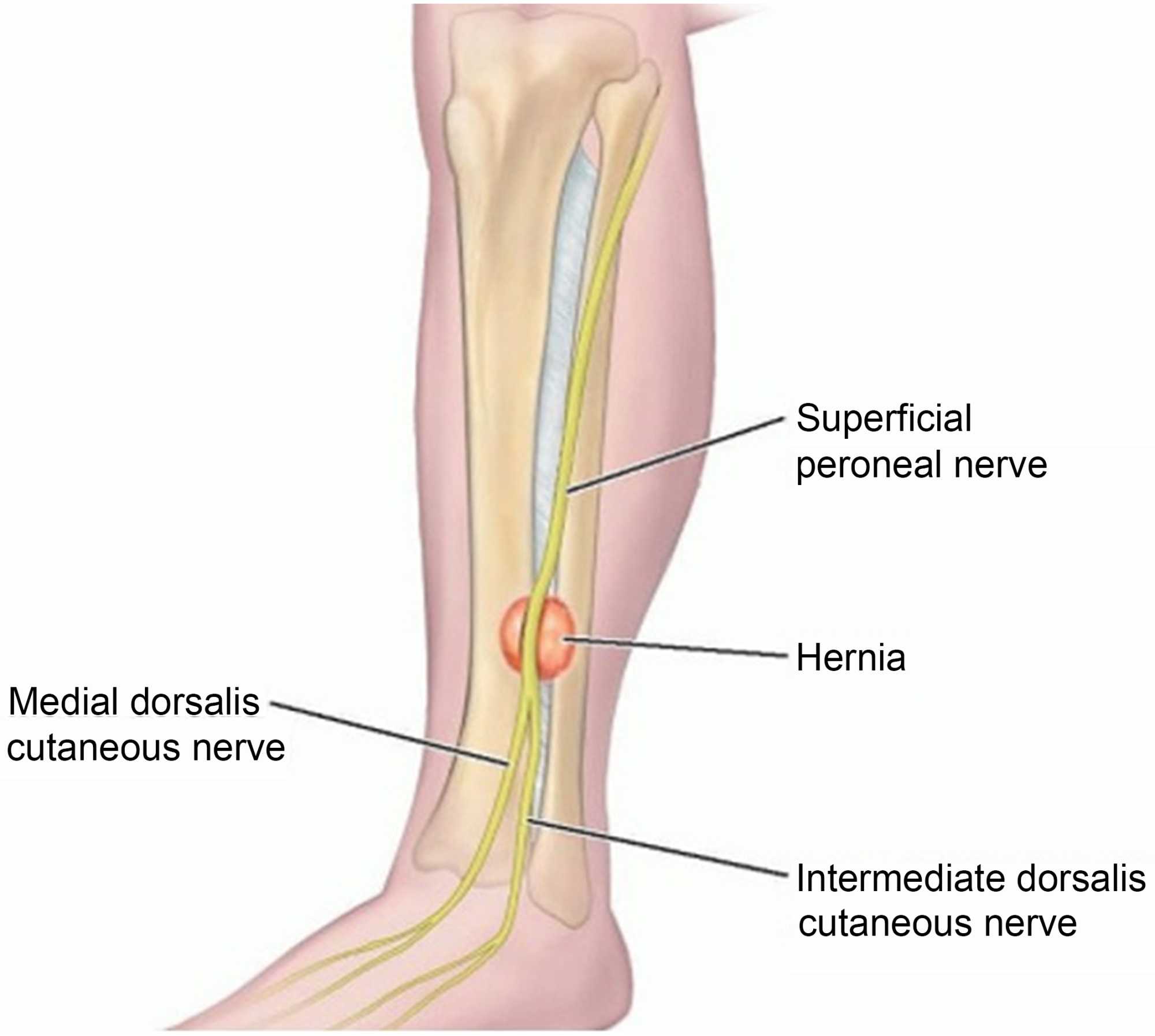 Anterior Tibialis Muscle Herniation in a Pediatric Patient, image size:2000x1794