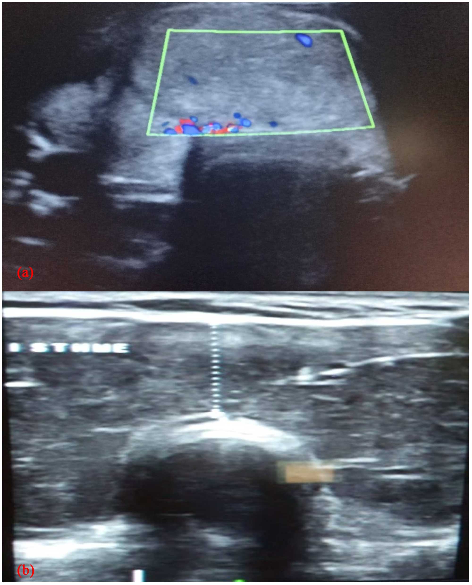 Ultrasound in Ti-Rads Classification of Thyroid Nodules at the Marie ...