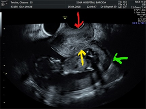 Stranded under the Prom: impacted gravid uterus presenting as acute urinary  retention