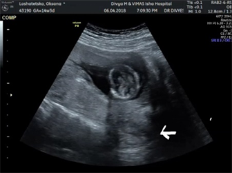 Figure 1 from Acute Urinary Retention Due to an Incarcerated Retroverted  Gravid Uterus