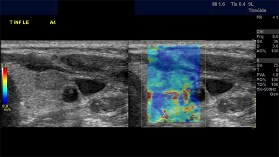 Cureus, B-mode Ultrasound Characteristics of Thyroid Nodules With  High-Benign Probability and Nodules With Risk of Malignancy