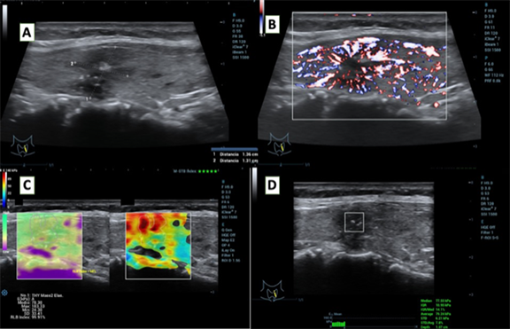 Cureus, B-mode Ultrasound Characteristics of Thyroid Nodules With  High-Benign Probability and Nodules With Risk of Malignancy