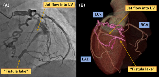Surgical Closure Of Coronary Cameral Fistula Draining Into The Left