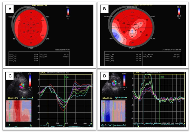 Abnormal left ventricular global longitudinal strain by speckle tracking  echocardiography in COVID-19 patients