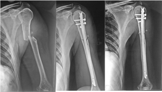 Humeral nailing revisited - ScienceDirect