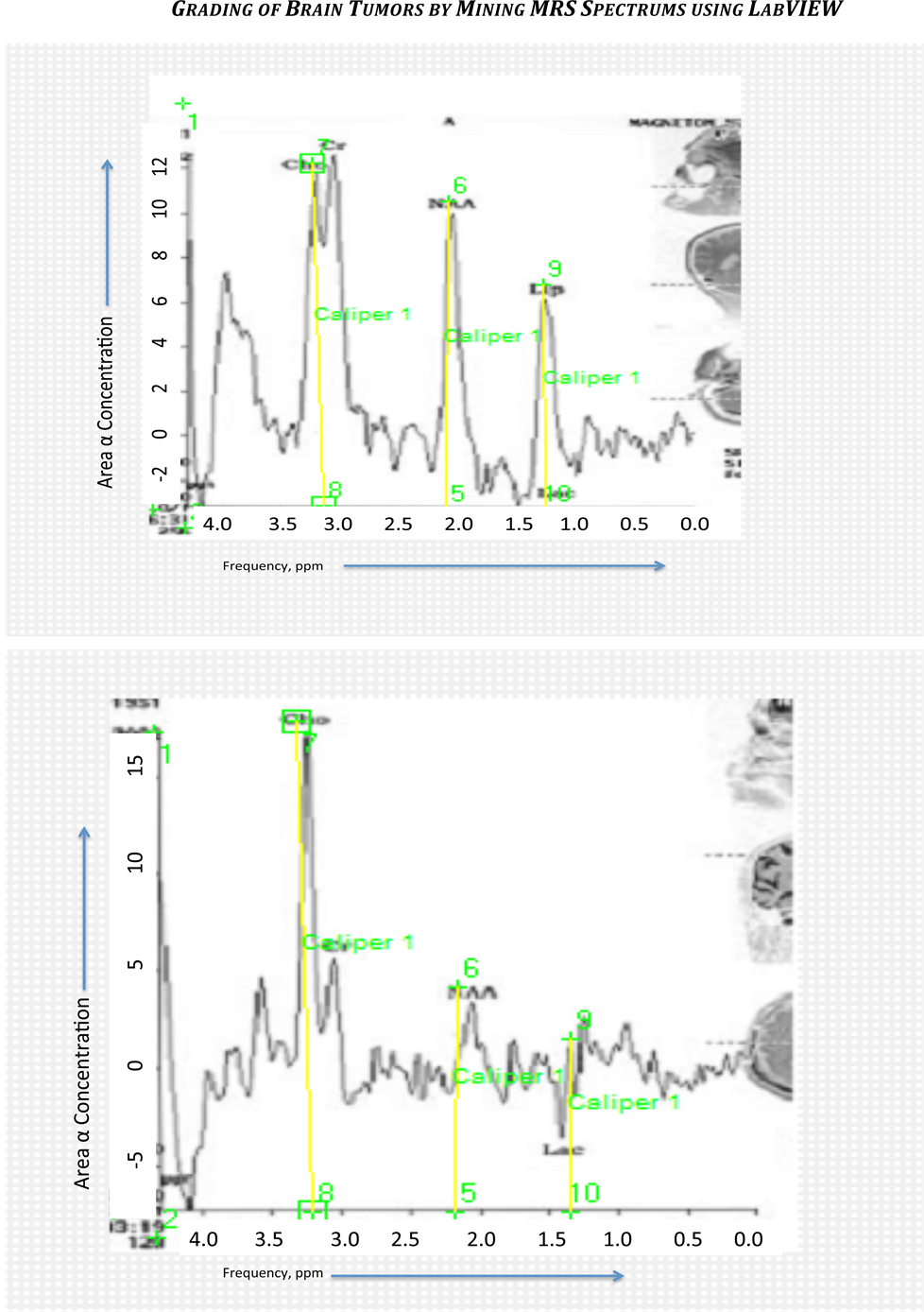 Grading of Brain Tumors by Mining MRS Spectrums Using LabVIEW ...