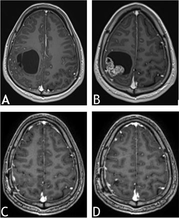 Supra-Tentorial Cortical Ependymoma in an Adult: Case Report and Review ...