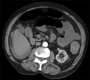 Acute Mesenteric Ischemia: A Challenging Diagnostic Disease—Four Cases ...
