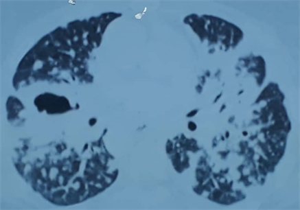 Pulmonary Aspergillus Fumigatus And Cryptococcus Neoformans Co Infection On An Underlying Sarcoidosis Condition Report Of A Rare Case