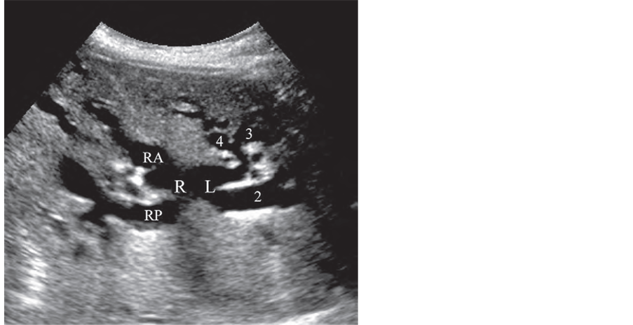 normal common bile duct ultrasound