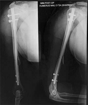 Arthroscopic removal of an intramedullary nail in the humerus | Knee  Surgery, Sports Traumatology, Arthroscopy