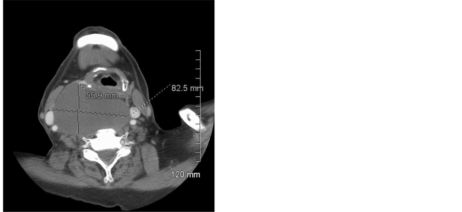 Parathyroid Adenoma Presenting As A Giant Cystic Neck Mass