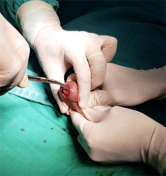 urethral stone: a rare cause of acute retention of urine in men