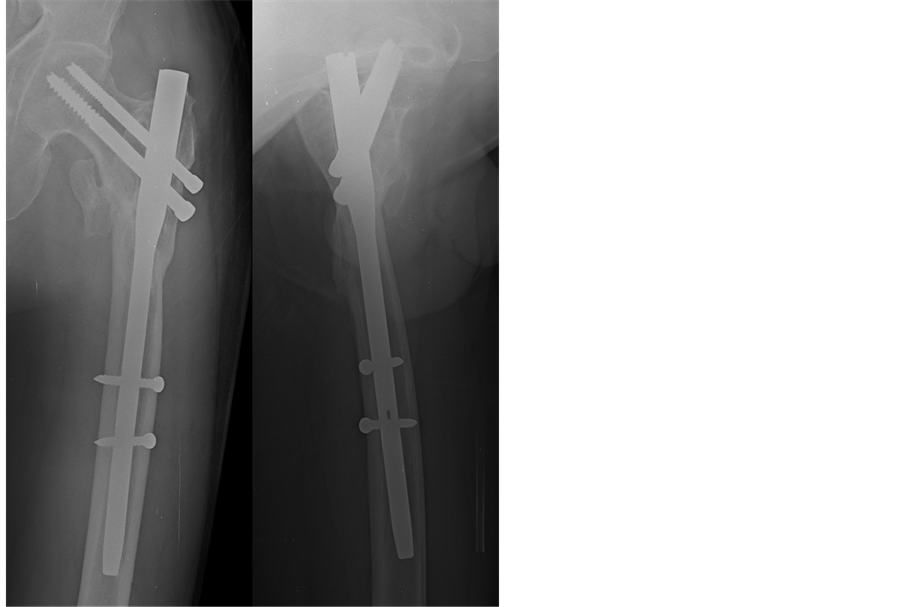 Mechanical failures after fixation with proximal femoral nail and risk | CIA