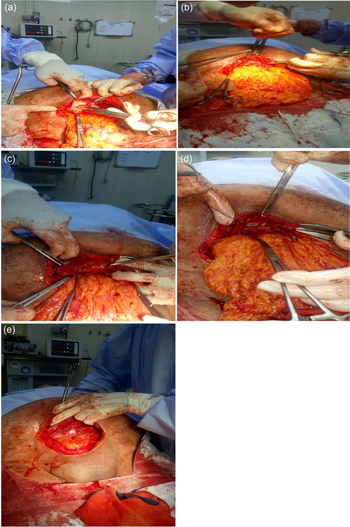 Simultaneous Repair of Para-Umbilical Hernia during Cesarean Section (CS):  A Novel Approach