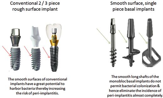 Convenient Dental Implant Services Sunbury OH