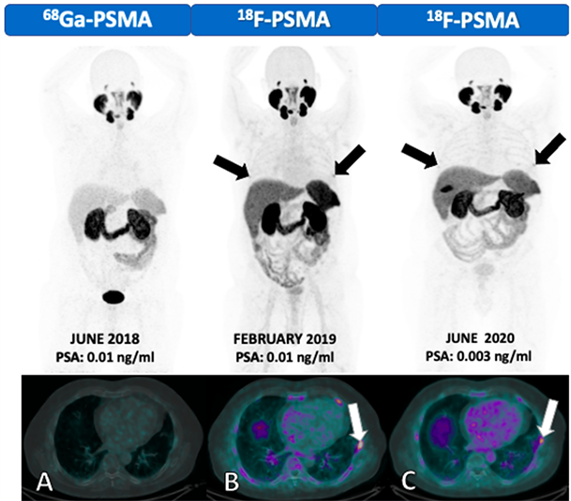 What To Do With a Positive PSMA PET and Negative Conventional Imaging in  Patients With Prostate Cancer