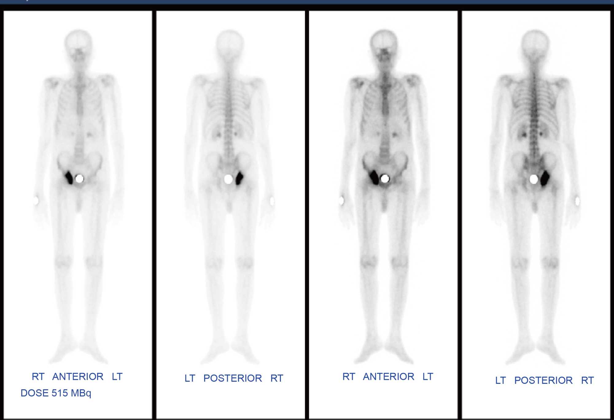 Solitary Osteolytic Bone Metastatic Lesion from Prostate Carcinoma: A Case  Report, image size:2000x1370
