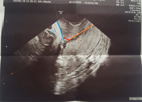 Ultrasound Evaluation of the Gravid Cervix