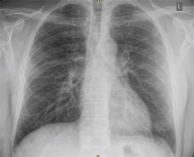 pneumonia lung fibrosis scarring rays quercetin pulmonary