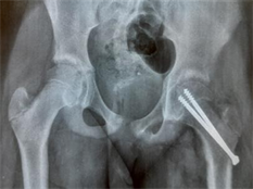 Femoral Hernia: A Review of the Clinical Anatomy and Surgical