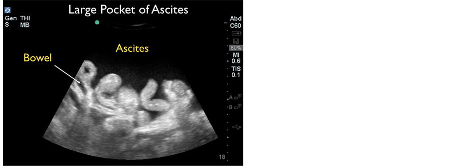 Ultrasound: Small pocket of ascites.