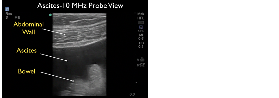 Ultrasound: Small pocket of ascites.