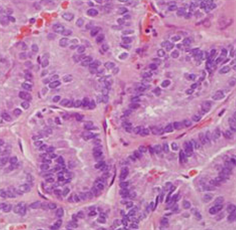 Current Understanding of Papillary Thyroid Carcinoma