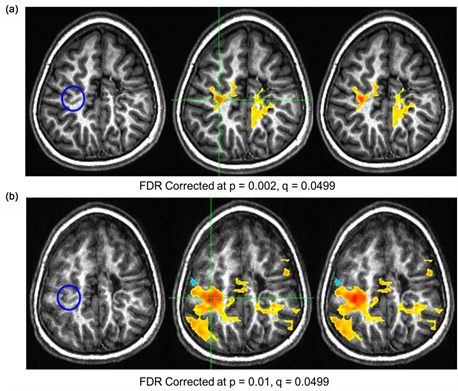 cerebral palsy brain scan comparison