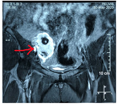 Unicentric Castleman’s Disease Presenting as ... Unicentric Castleman’s Disease Presenting as ...