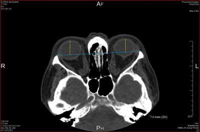 Hertel Exophthalmometry and Computed Tomography for the Evaluation of