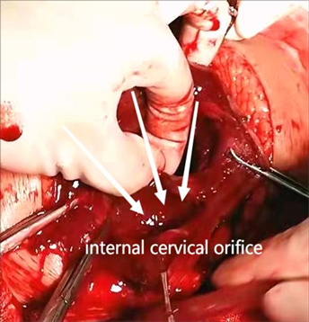 Clinical Experience of Patients with Full-Term Uterine