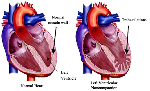 Acute on Chronic Heart Failure Secondary to Left Ventricular Noncompaction