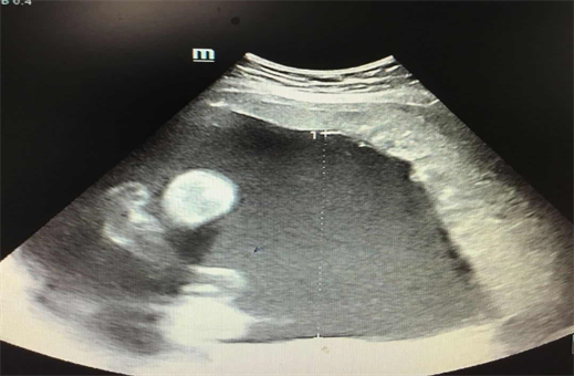 signs of leaking amniotic fluid