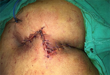 Excision of Extensive Recurrent Pilonidal Cyst with Gluteus Muscle Fascia  Plasty & Mid-line Closure 